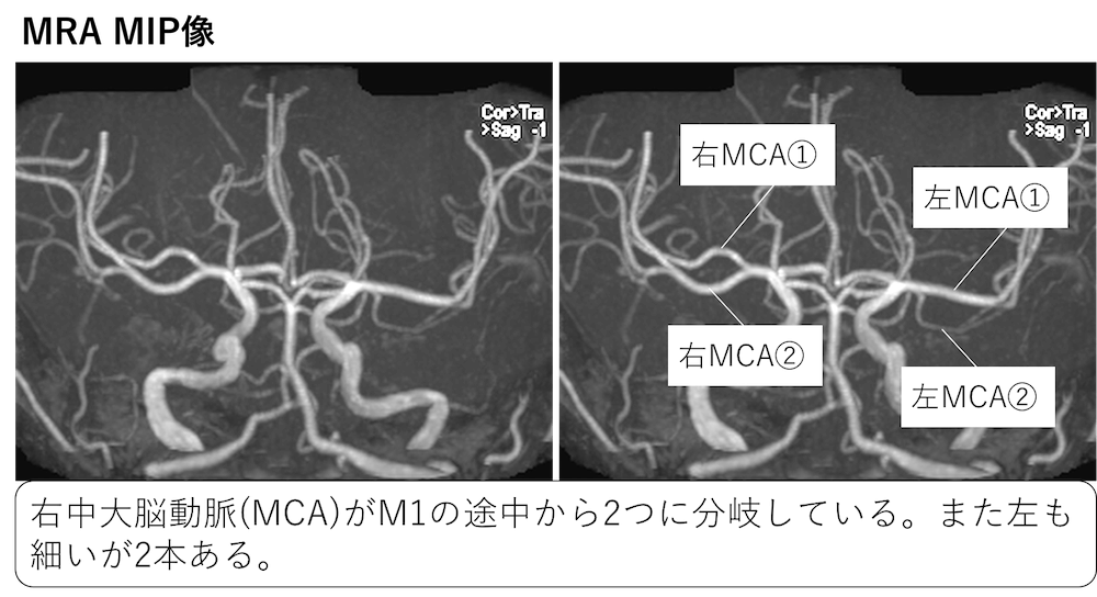 中大脳動脈の破格・正常変異とは？